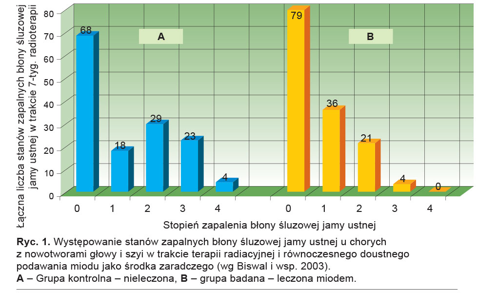 Występowanie stanów zapalnych błony śluzowej jamy ustnej u chorych z nowotworami głowy i szyi w trakcie terapii radiacyjnej i równoczesnego doustnego podawania miodu jako środka zaradczego (wg Biswal i wsp. 2003). 