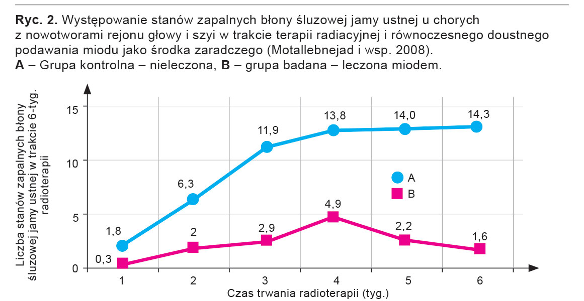 Występowanie stanów zapalnych błony śluzowej jamy ustnej u chorych z nowotworami głowy i szyi w trakcie terapii radiacyjnej i równoczesnego doustnego podawania miodu jako środka zaradczego (wg Biswal i wsp. 2003). 